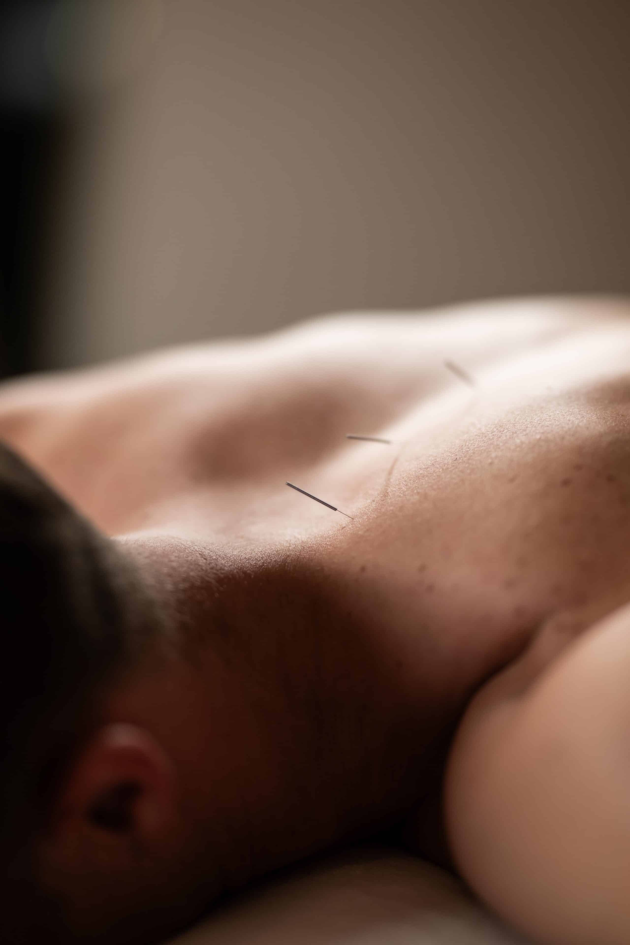 acupuncture at brach madrid hotel at la capsule spa & sports club